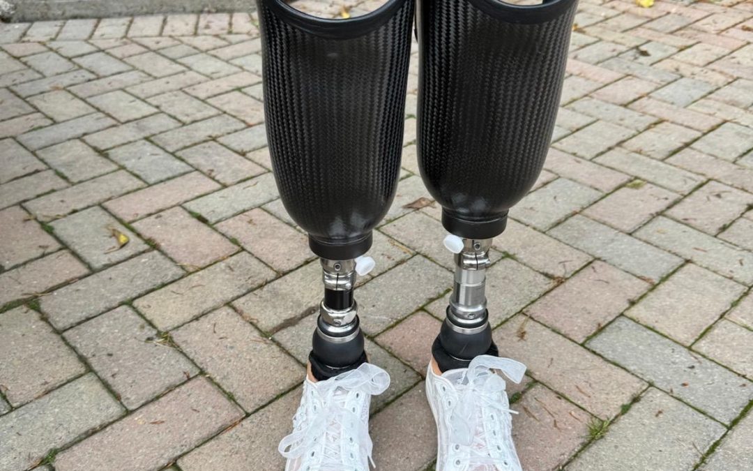PLYMOUTH NURSE WALKS DOWN THE AISLE AFTER  LOSING BOTH HER LEGS TO SEPSIS