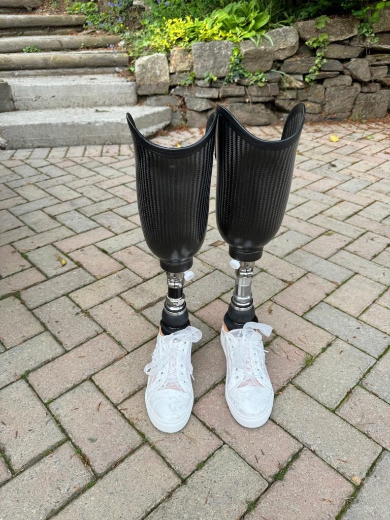 Prosthetic legs with white wedding trainers